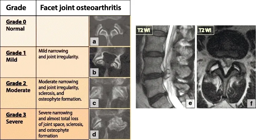 Chart comparing normal facet joints with mild, moderate and severe facet joint osteoarthritis on CT and MRI