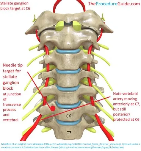 Fluoroscopic image showing SGB procedure