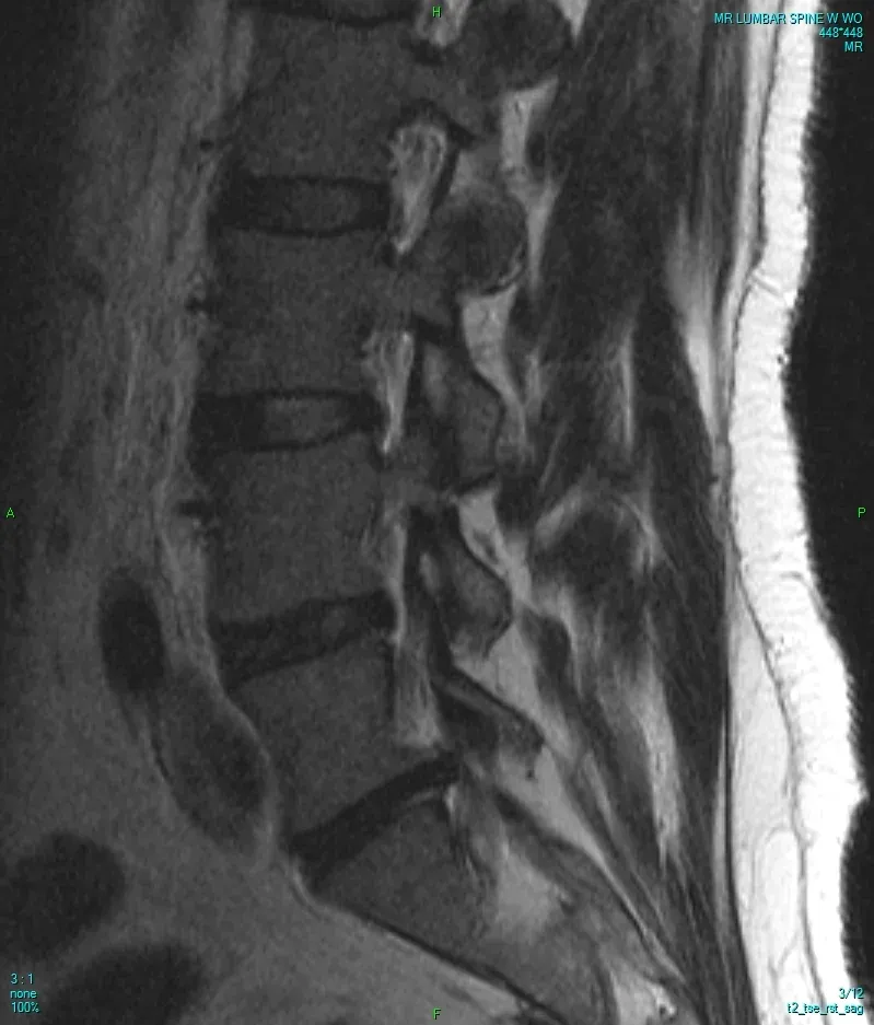 Sagittal MRI of the lumbar spine showing vertebral bodies, discs and the spinal canal