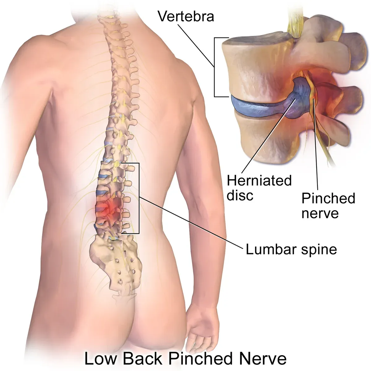 Medical illustration of a herniated lumbar disc pressing on a spinal nerve root