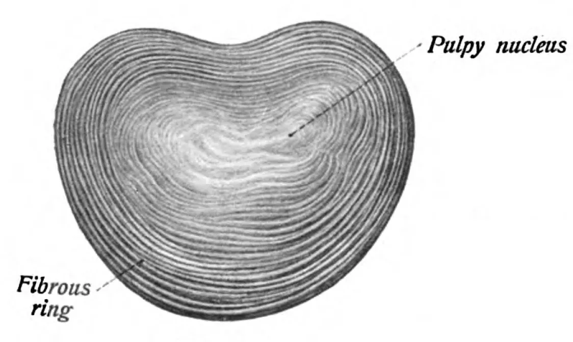 Cross-section of an intervertebral disc showing the soft central nucleus surrounded by concentric fibrous rings