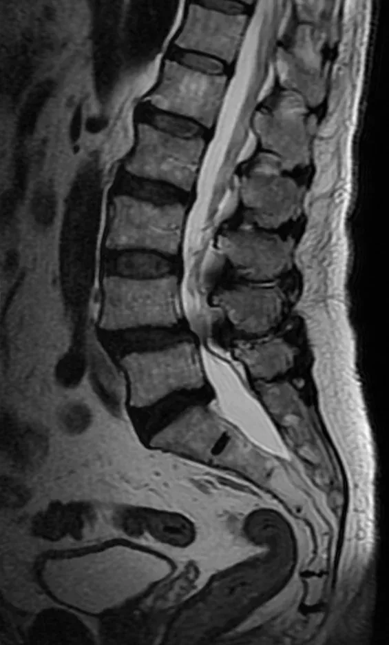 Sagittal MRI of the lumbar spine showing narrowing of the spinal canal