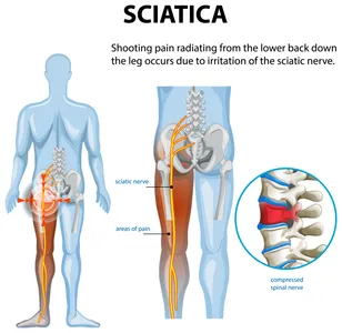 What Is Sciatica Really? Understanding Lumbar Radiculopathy, Causes, and Treatments That Actually Work