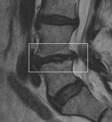 MRI showing Modic changes in the spine