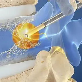 Intracept Procedure Illustration