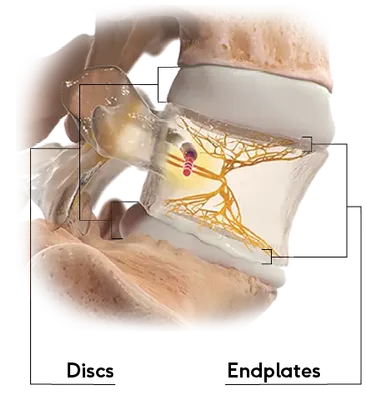 Vertebrogenic Pain Illustration showing discs and endplates